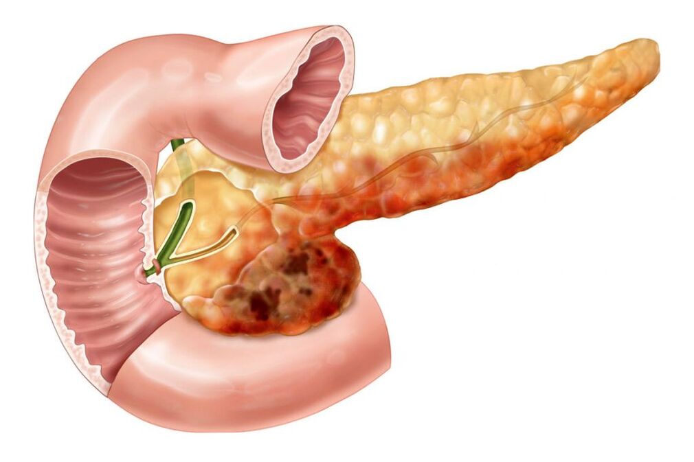Dor nas costas por pancreatite