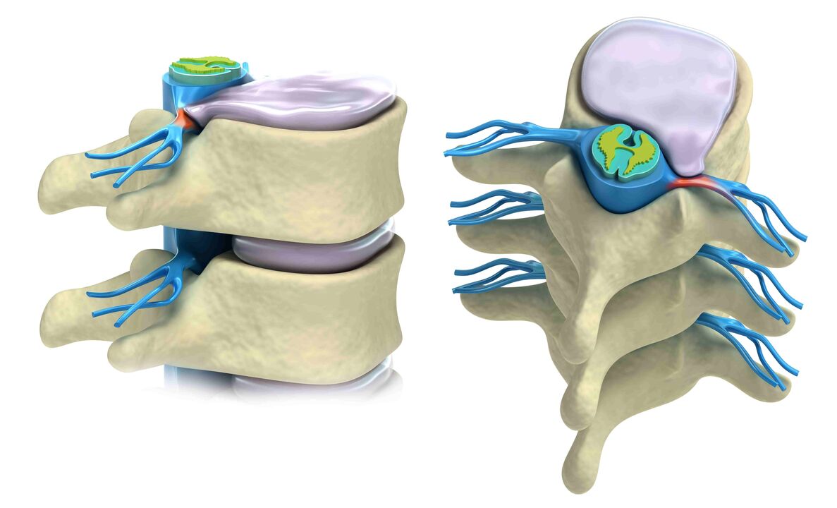 disco intervertebral danado