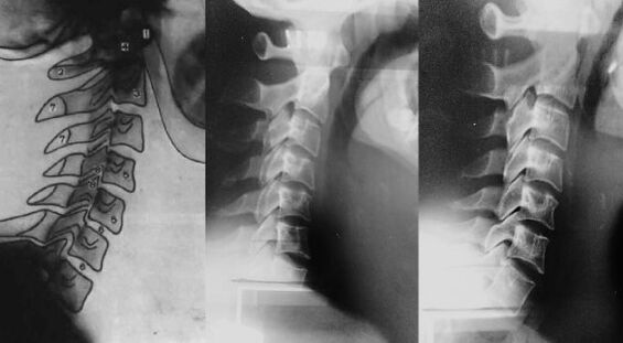 Pescozo cun cambio das primeiras vértebras cervicais
